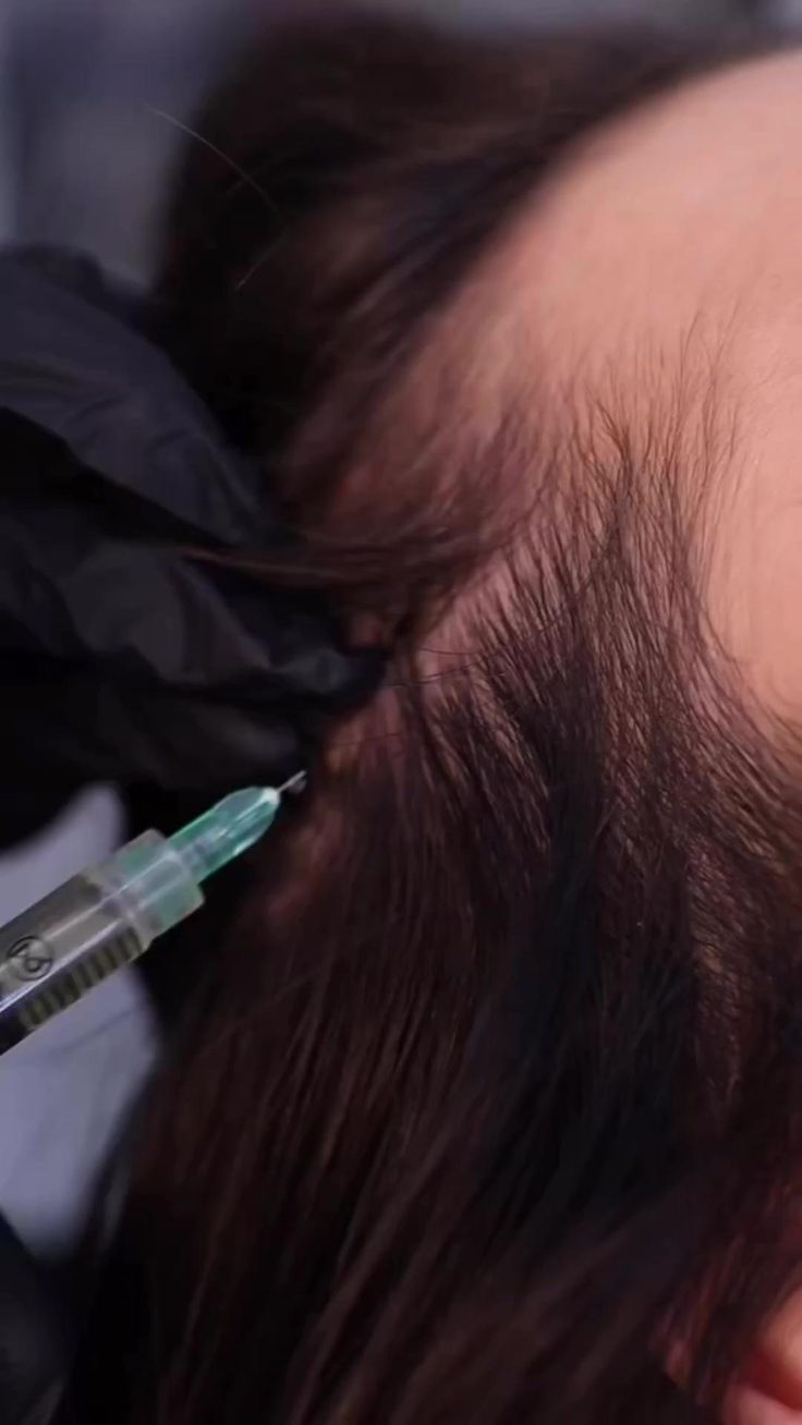 prp-treatment