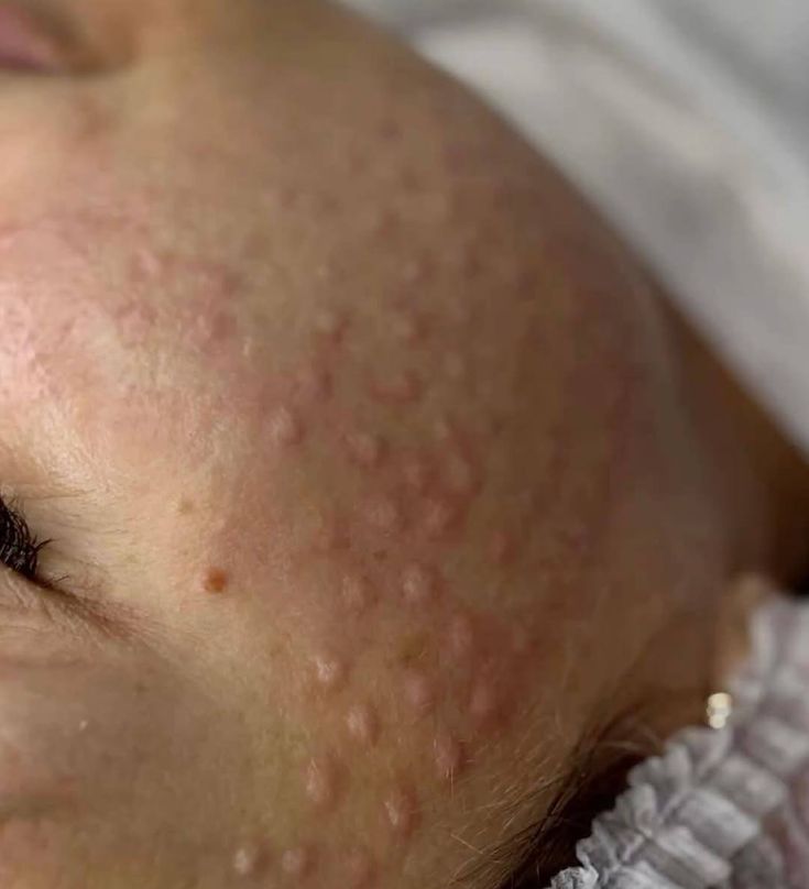 skin-booster